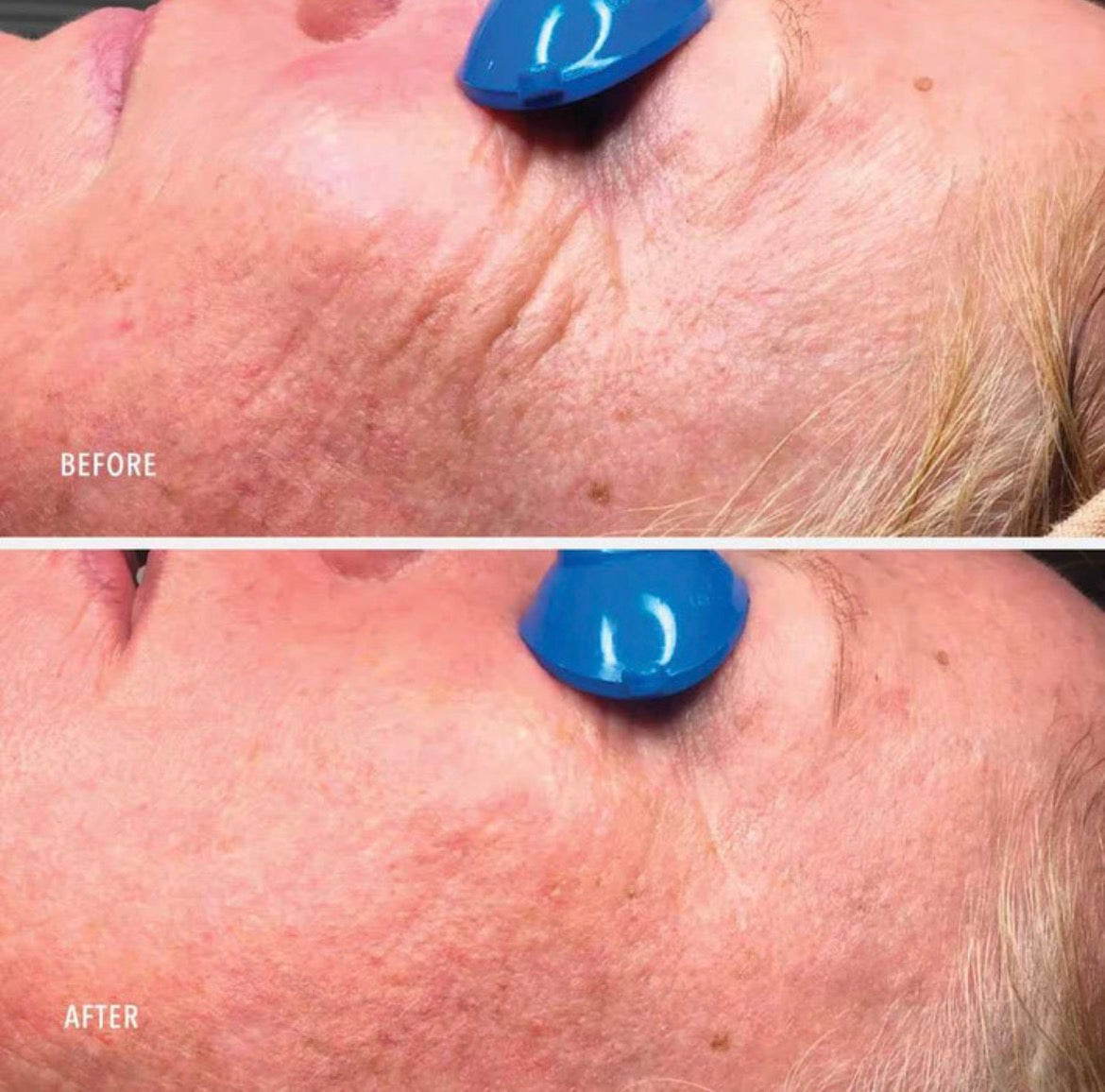 Collagen Reactive PM