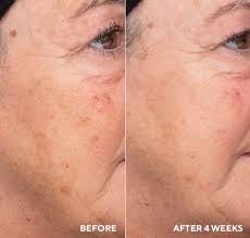 Liquid resurfacing solution Hydropeptide