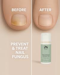 Nail fungus protect